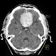 Meningioma of cribous lamina: CT - Computed tomography